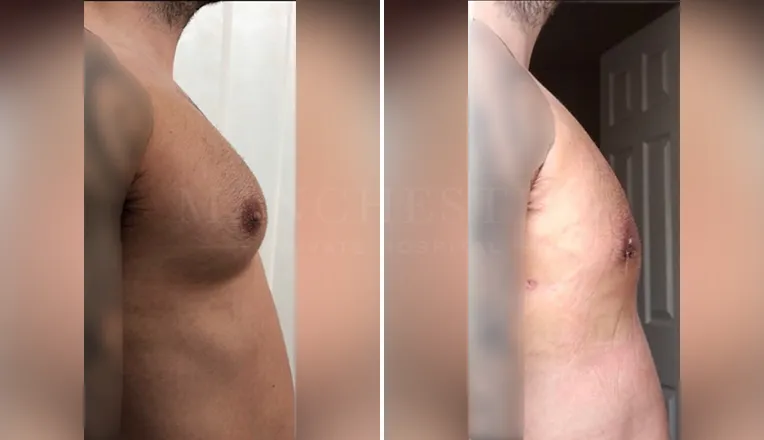 gynecomastia before and after patient -6