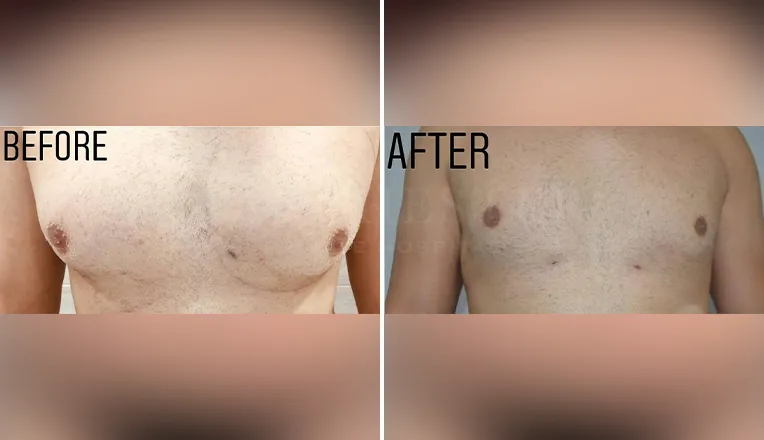 gynecomastia before and after patient -7