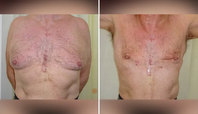 gynecomastia liposuction before and after patient -1 - v1