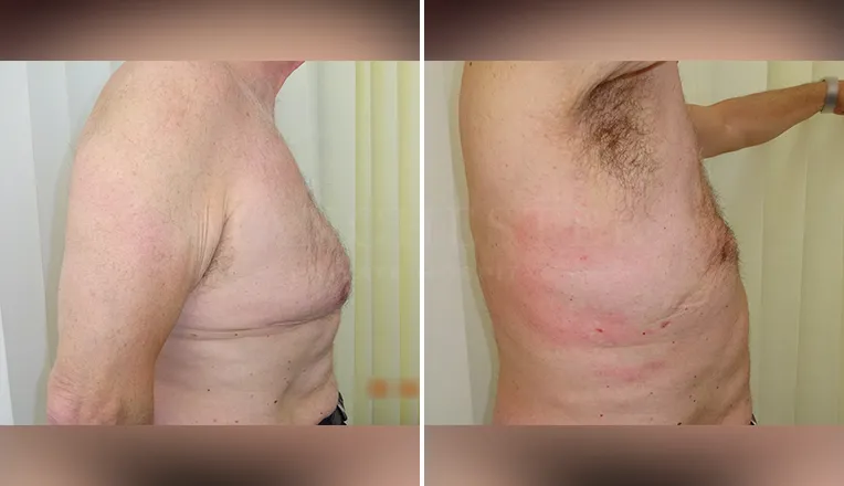 gynecomastia liposuction before and after patient -1 - v2