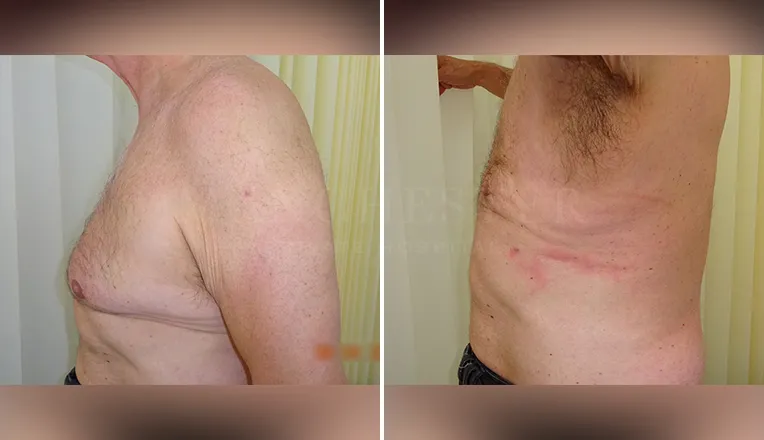 gynecomastia liposuction before and after patient -1 - v3