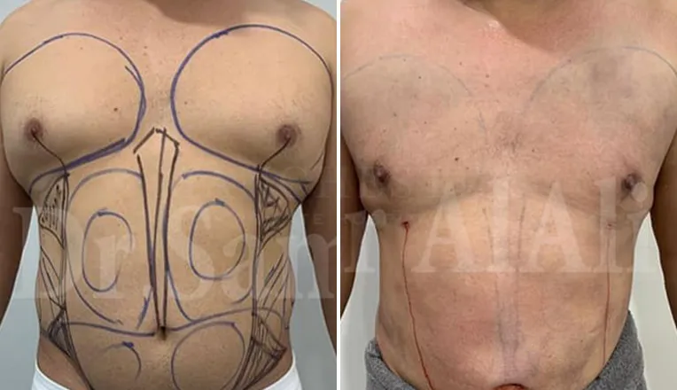 gynecomastia liposuction before and after patient -1