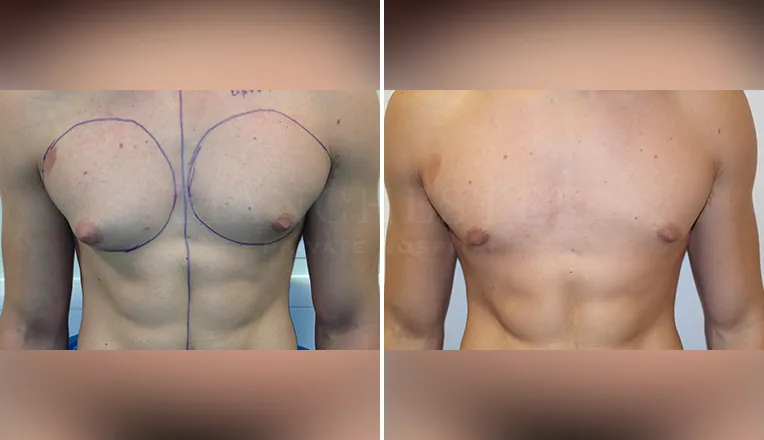 gynecomastia liposuction before and after patient -2 - v1