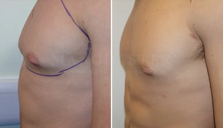 gynecomastia liposuction before and after patient -2 - v2