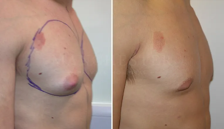 gynecomastia liposuction before and after patient -2 - v3