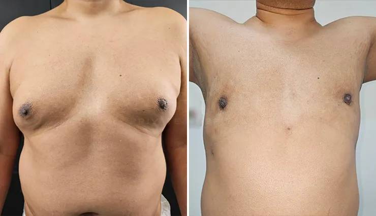gynecomastia liposuction before and after patient -2