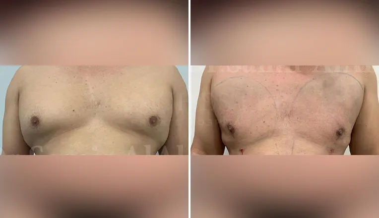 gynecomastia liposuction before and after patient -3