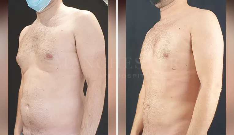 gynecomastia liposuction before and after patient -4 - v1