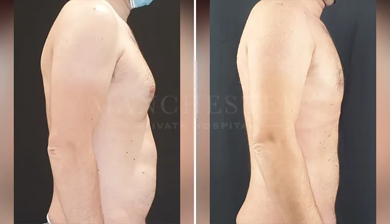 gynecomastia liposuction before and after patient -4 - v2