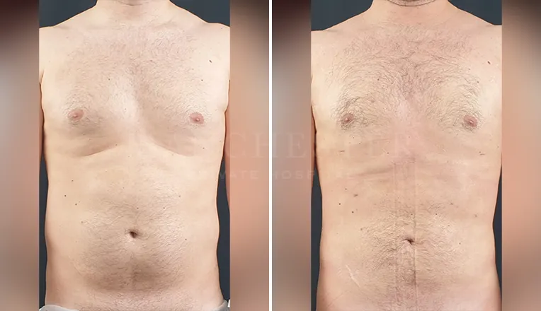 gynecomastia liposuction before and after patient -4