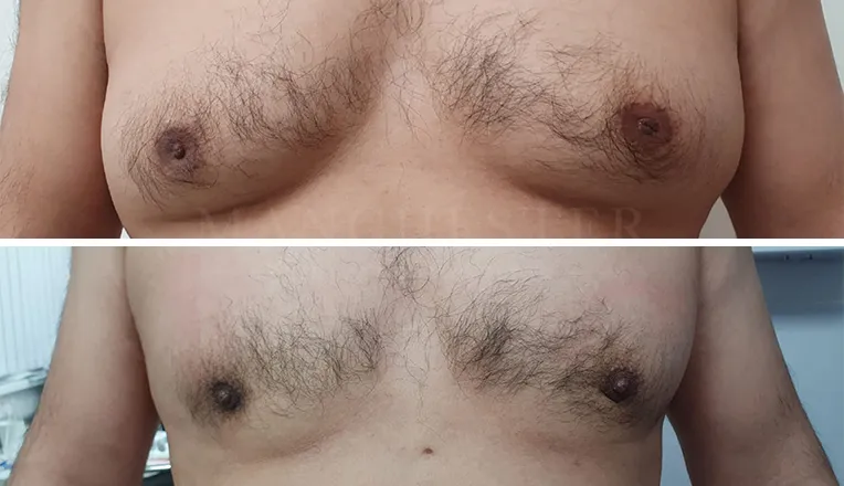 gynecomastia liposuction before and after patient -6