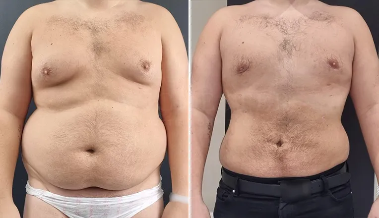 gynecomastia liposuction before and after patient -7