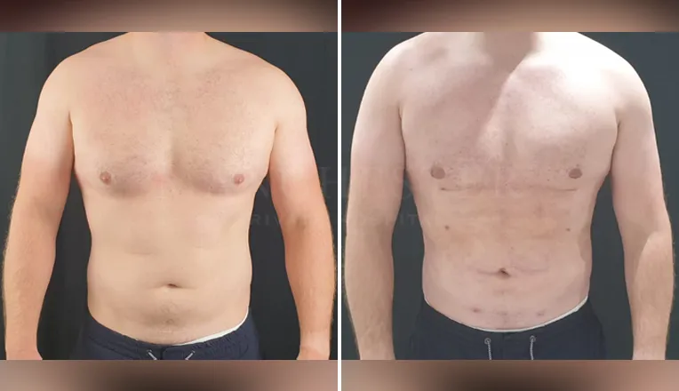 gynecomastia liposuction before and after patient -8