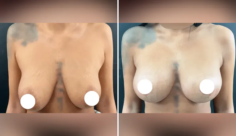 mastopexy augmentation before and after patient - v1