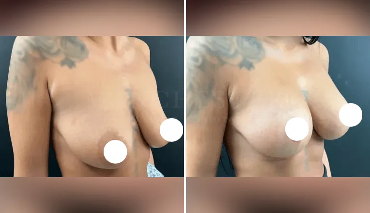mastopexy augmentation before and after patient - v3