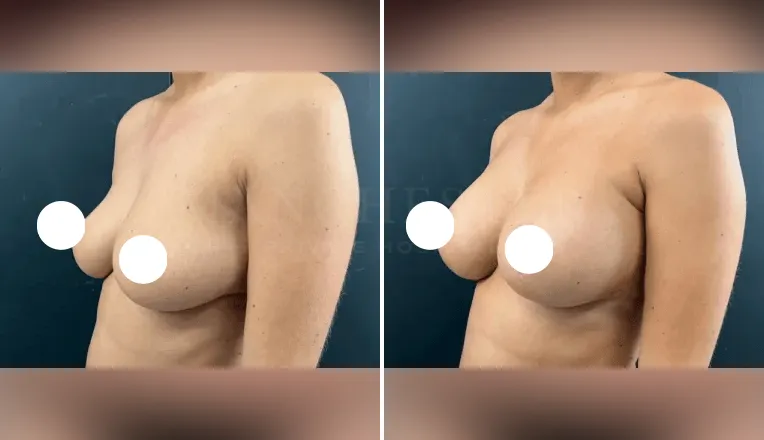 mastopexy breast augmentation before and after patient - v2