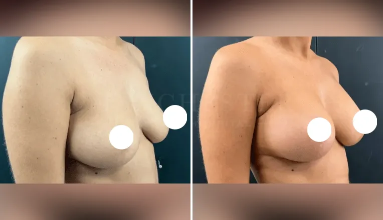 mastopexy breast augmentation before and after patient - v3