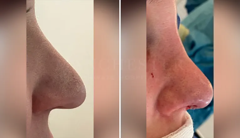 nose job before and after patient - 1