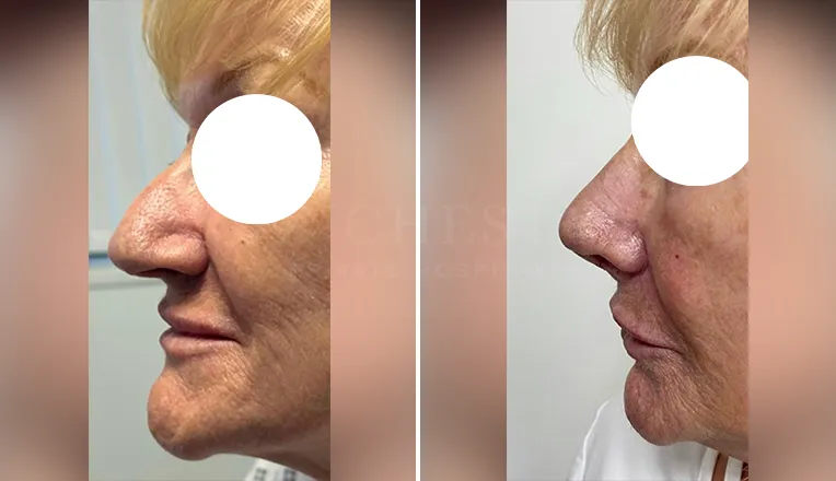 nose job before and after patient - 3