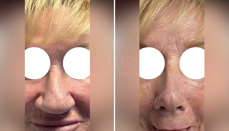 nose job before and after patient - 4