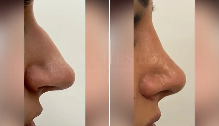 rhinoplasty before and after patient - 1