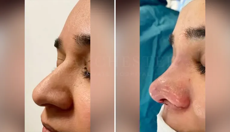 rhinoplasty before and after patient - 3