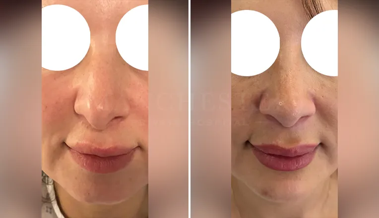 rhinoplasty before and after patient - 4