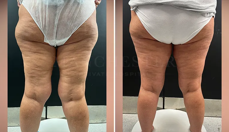 thigh vaser lipo before after patient
