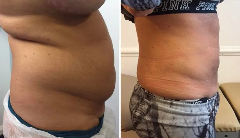tummy tuck before and after-5