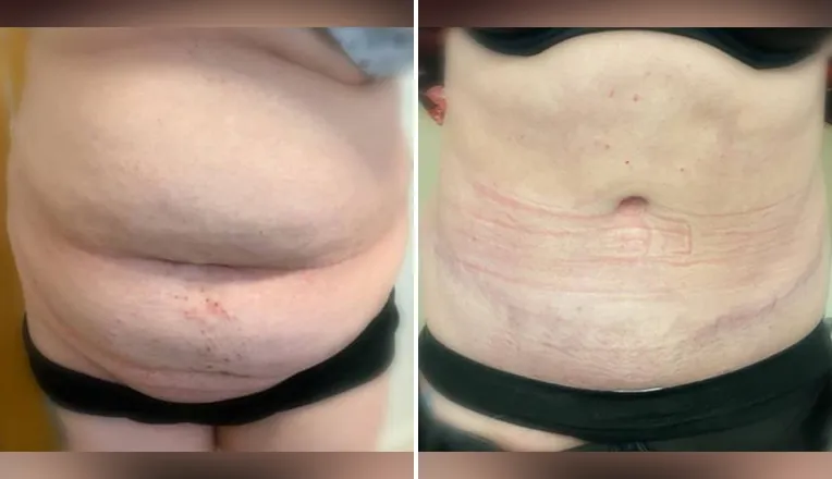 tummy tuck before and after-6