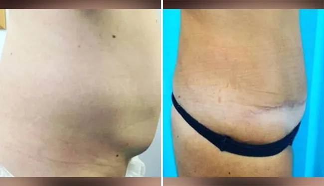 tummy tuck before and after result-5