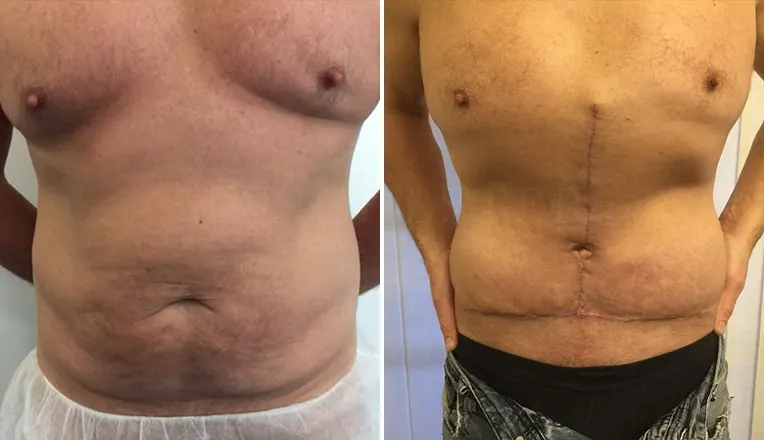 tummy tuck before and after result-7