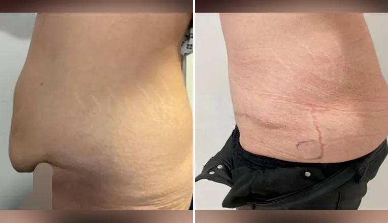 tummy tuck before and after uk-3