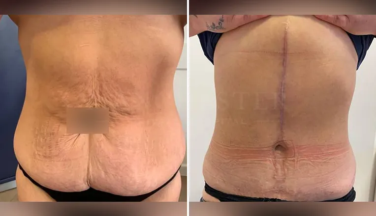 tummy tuck before and after uk-4