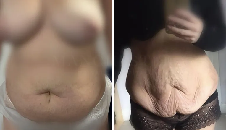 tummy tuck before and after uk-6