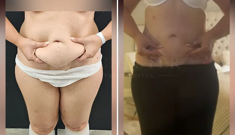vaser lipo before and after stomach-3
