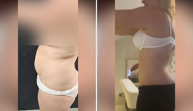 vaser lipo female abs before and after-3