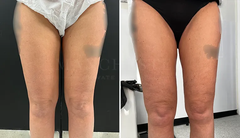 vaser lipo legs before and after patient-2
