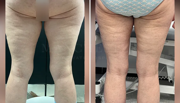 vaser lipo legs before and after patient