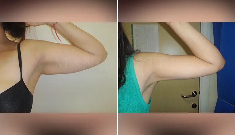 vaser lipo on arms before and after patient - 1 - v1