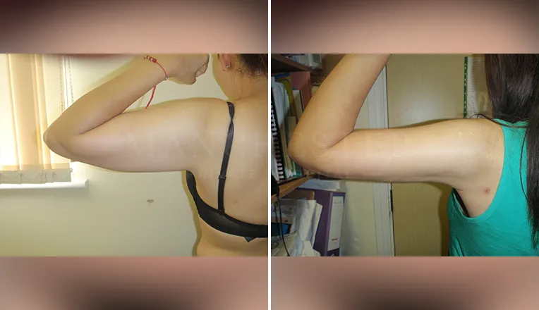 vaser lipo on arms before and after patient - 1 - v2