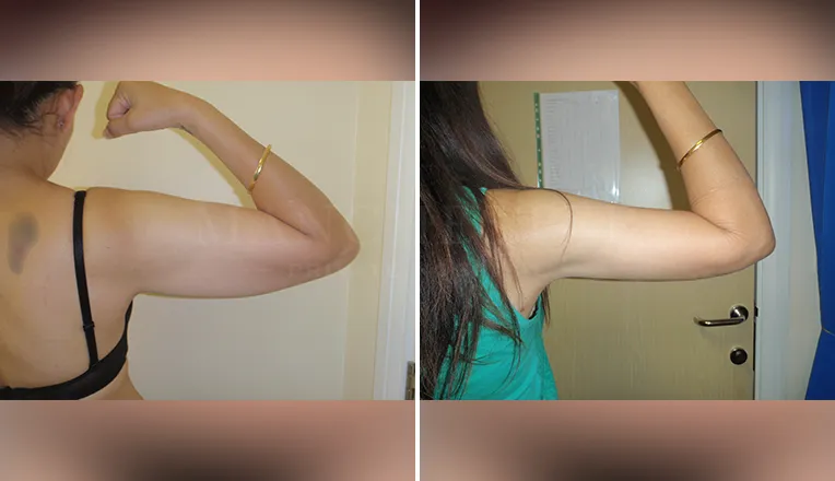 vaser lipo on arms before and after patient - 1 - v3