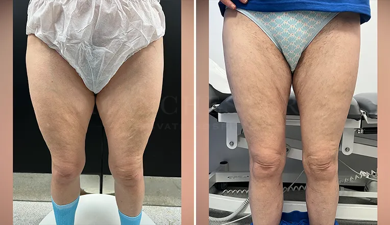 vaser lipo thighs before after patient - 1 - v2