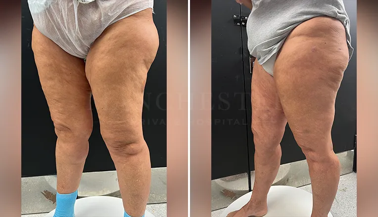 vaser lipo thighs before after patient - 1 - v3