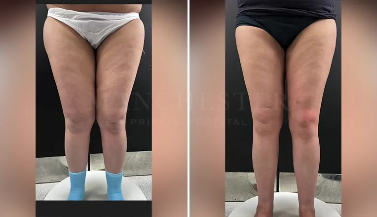 vaser lipo thighs before after patient-1