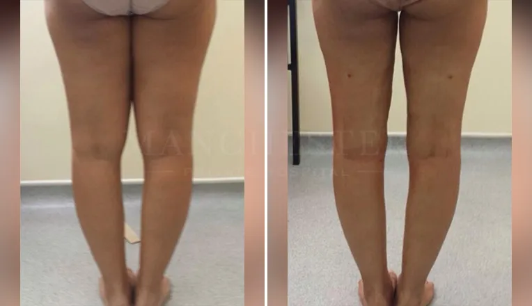 vaser lipo thighs before after patient - 3 - v2