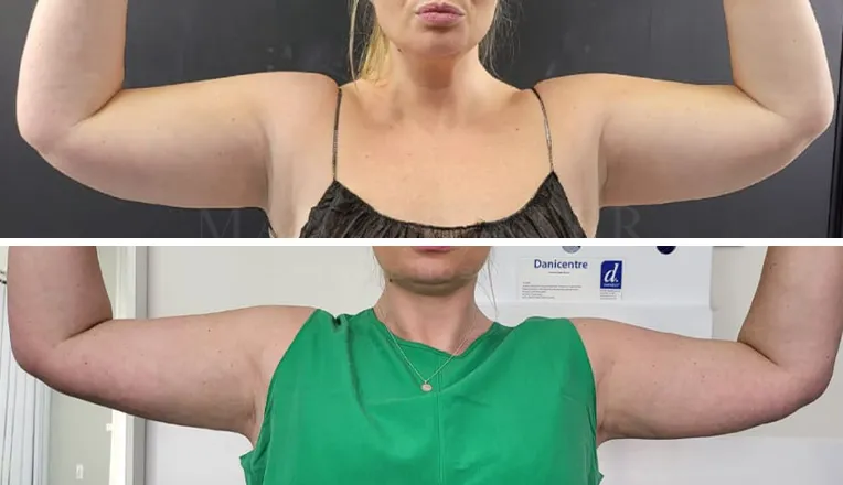 vaser liposuction arms before and after patient - v1