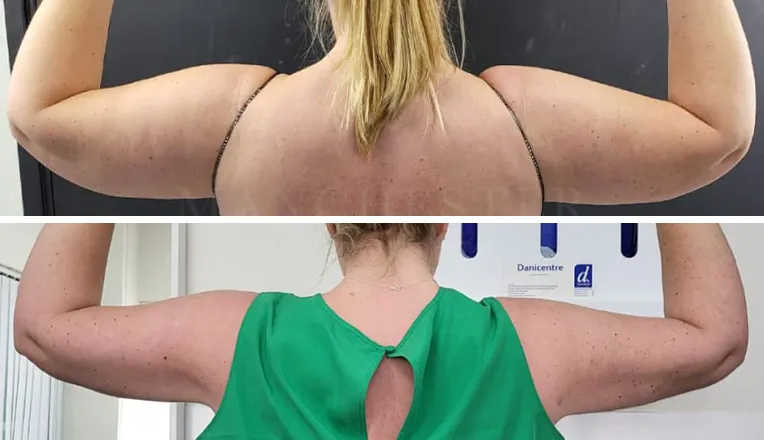 vaser liposuction arms before and after patient - v2