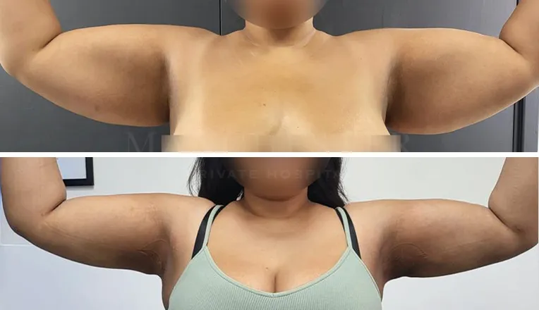 vaser liposuction arms before and after patient