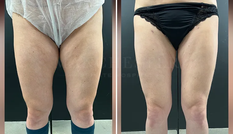 vaser liposuction legs before and after patient-1